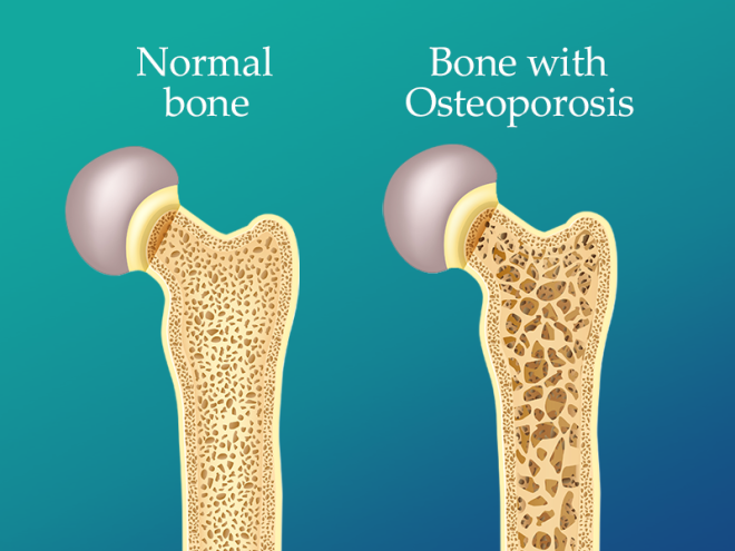 How to Prevent Osteoporosis | 6 Ways to Avoid it | Orthopedic Institute ...