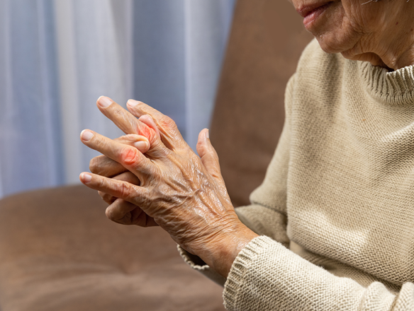Signs of psoriatic arthritis