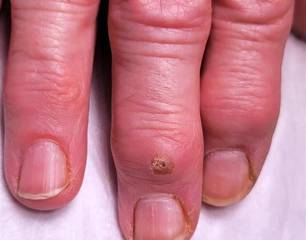 What Is a Digital Mucous Cyst? What That Bump Near Your Fingernail ...