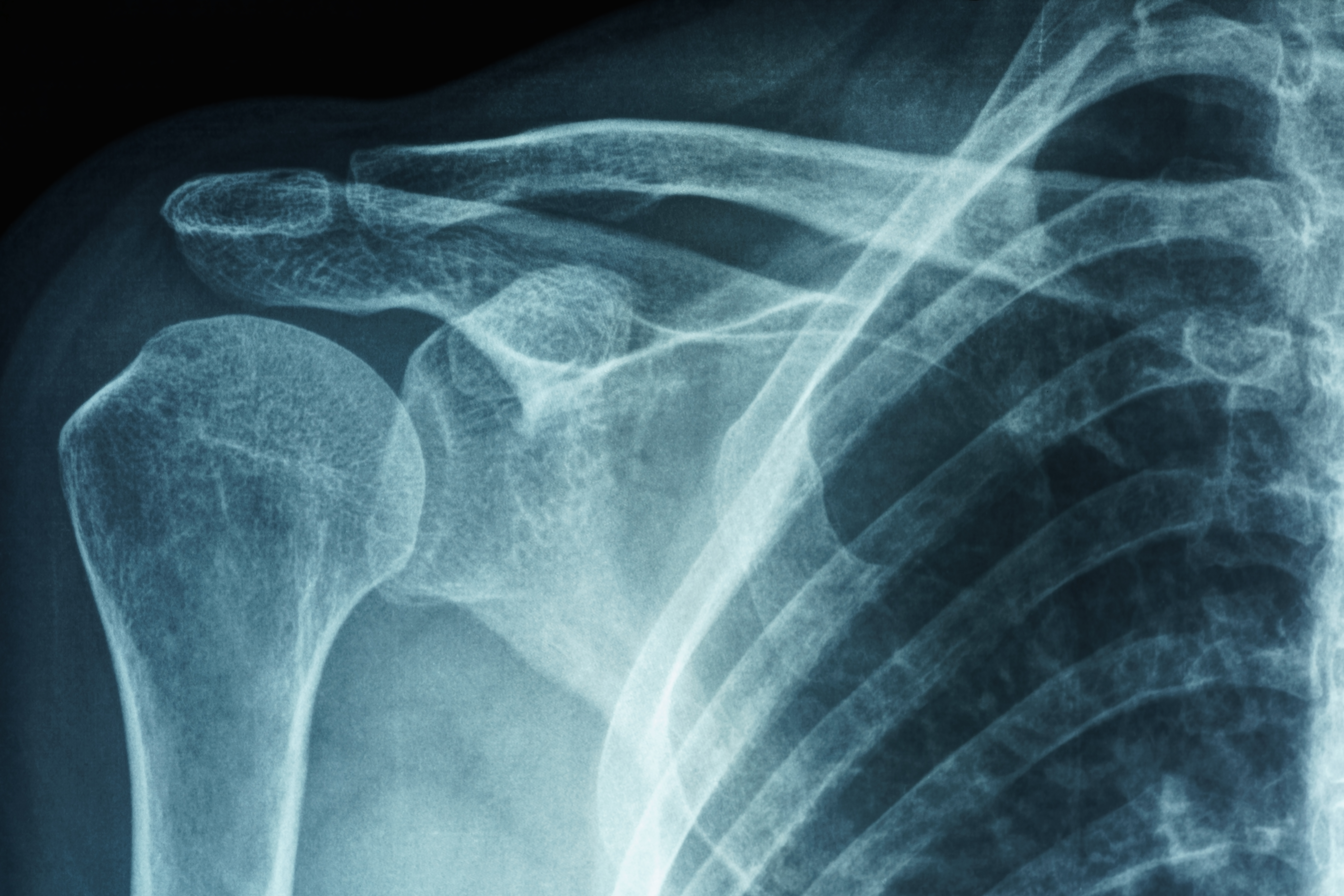 Frozen Shoulder (Adhesive Capsulitis)